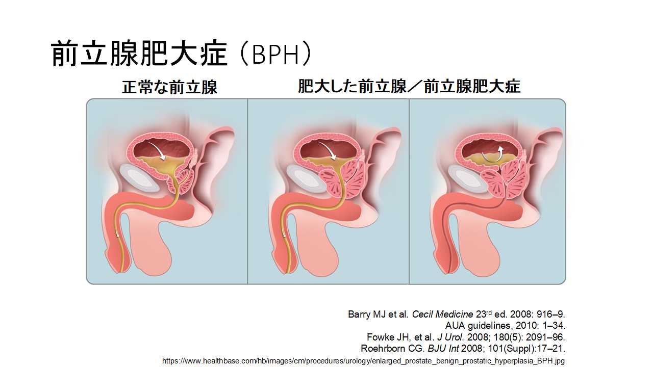 前立腺肥大症（BPH）